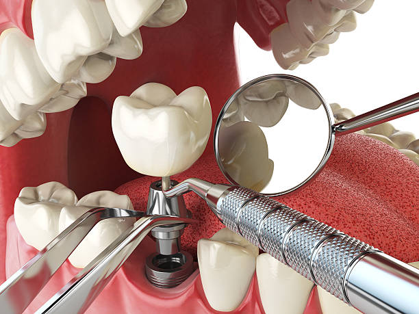 Best Urgent Tooth Repair  in Gunnison, CO